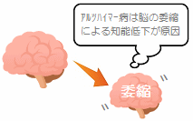 脳の萎縮イメージ